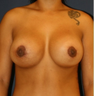 Feel Beautiful - Breast Augmentation-Lift 50 - After Photo